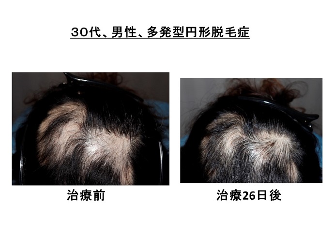 円形脱毛症　病院